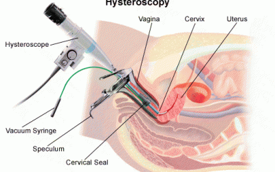 Histeroskopi Nedir?